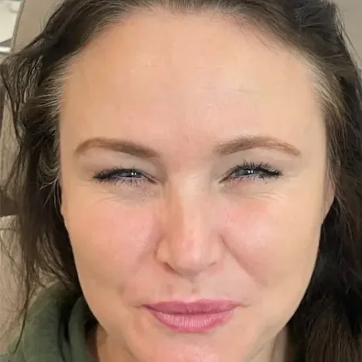 After: anti-wrinkle injections, frown lines
