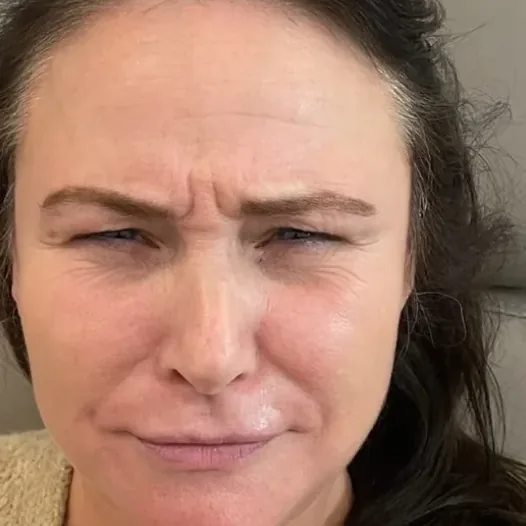Before: anti-wrinkle injections, frown lines
