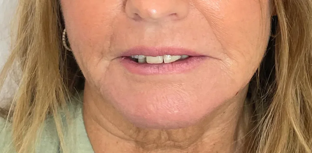 After: dermal filler, chin and jowls