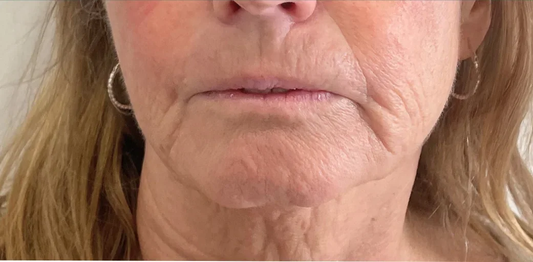 Before: dermal filler, chin and jowls