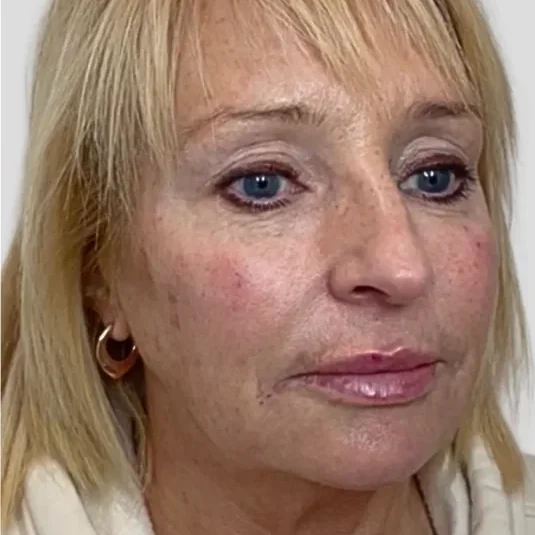 After: dermal filler, full face
