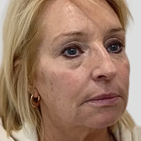 Before: dermal filler, full face