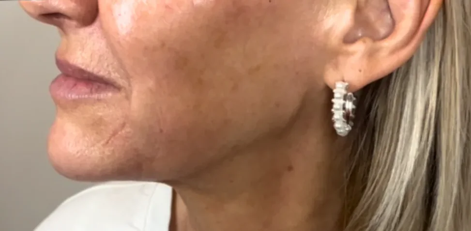 After: dermal filler, jawline