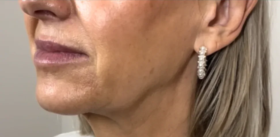 Before: dermal filler, jawline