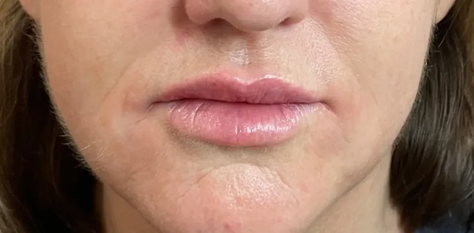 After: lip filler, lips