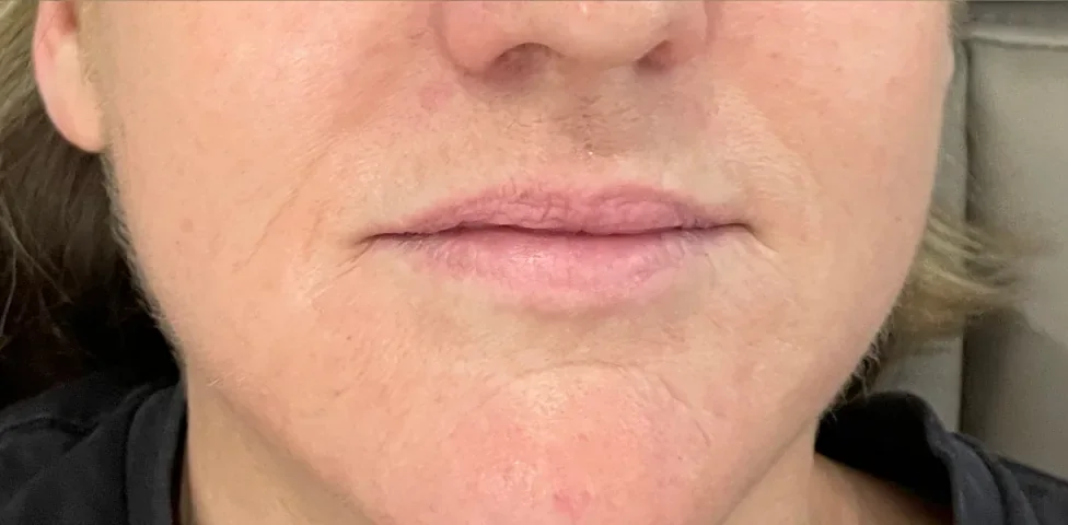 Before: lip filler, lips