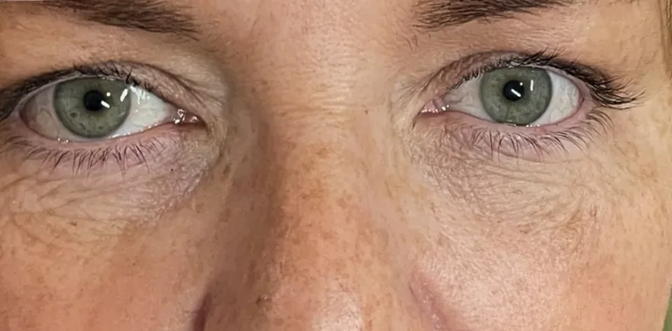 After: polynucleotides, under-eyes