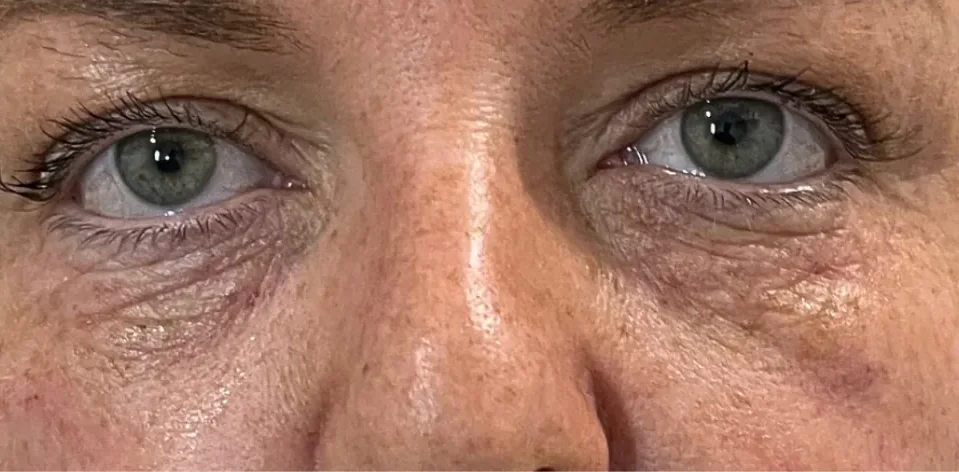 Before: polynucleotides, under-eyes