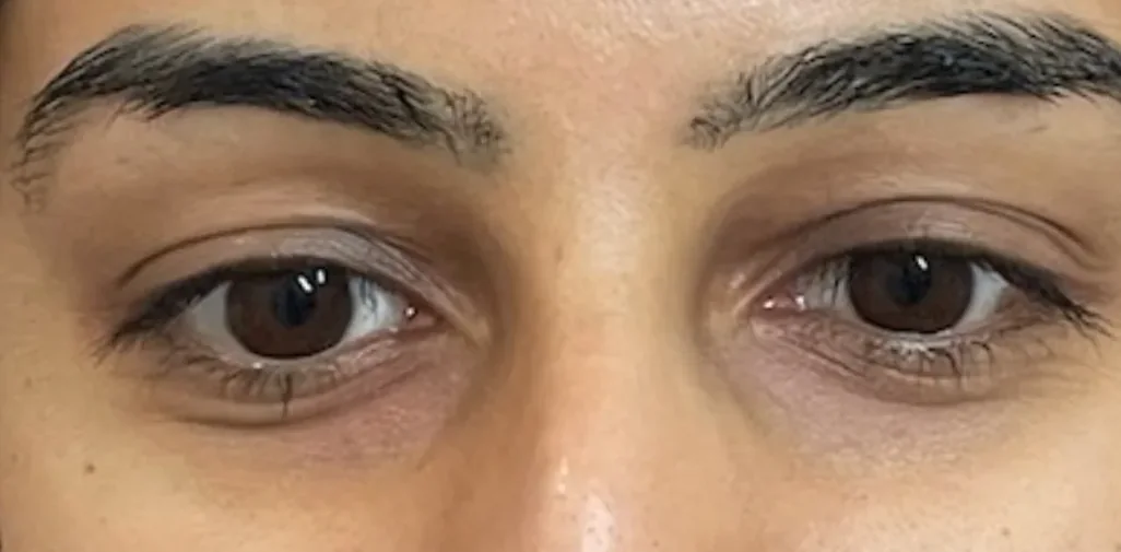 After: polynucleotides, under-eyes