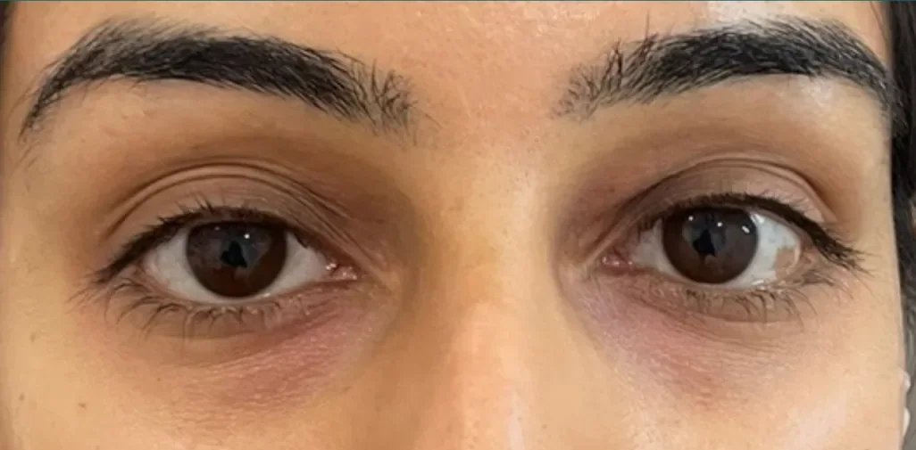 Before: polynucleotides, under-eyes