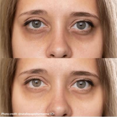 polynucleotides-under-eyes
