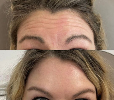 anti-wrinkle-botox-injections-kings-cross-longon
