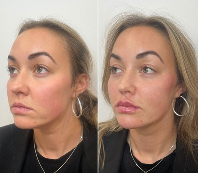 filler-treatment-kings-cross