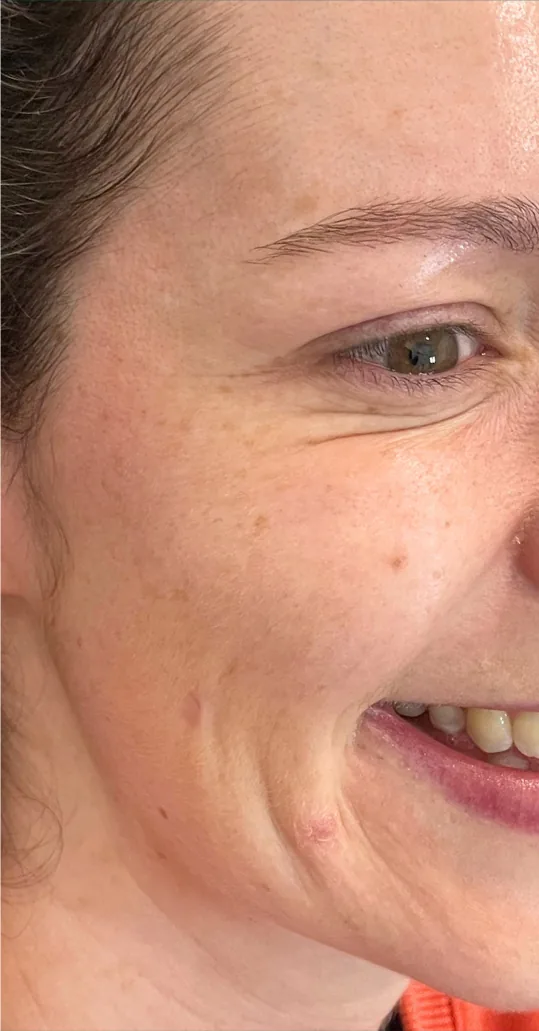 After anti-wrinkle injections, crow's feet