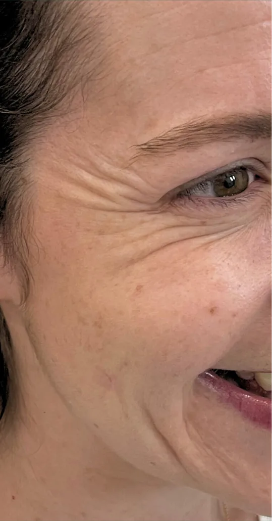 Before anti-wrinkle injections, crow's feet