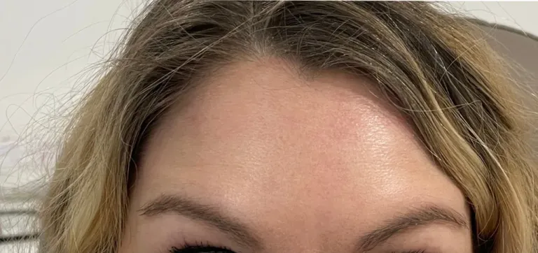 After anti-wrinkle injections, forehead lines