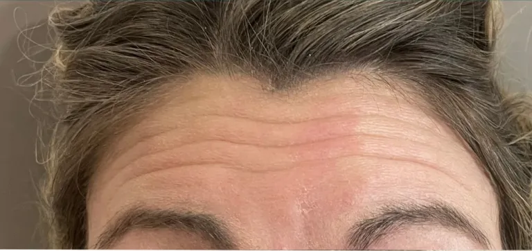 Before anti-wrinkle injections, forehead lines
