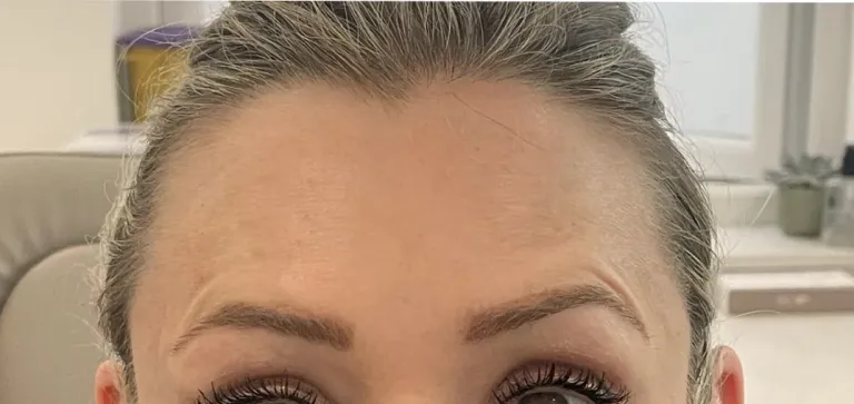 After anti-wrinkle injections, forehead lines