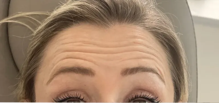 Before anti-wrinkle injections, forehead lines