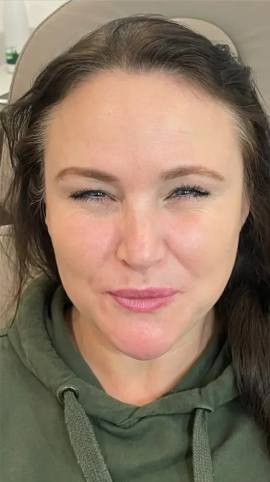 After anti-wrinkle injections, frown lines