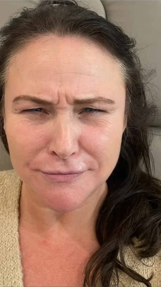 Before anti-wrinkle injections, frown lines