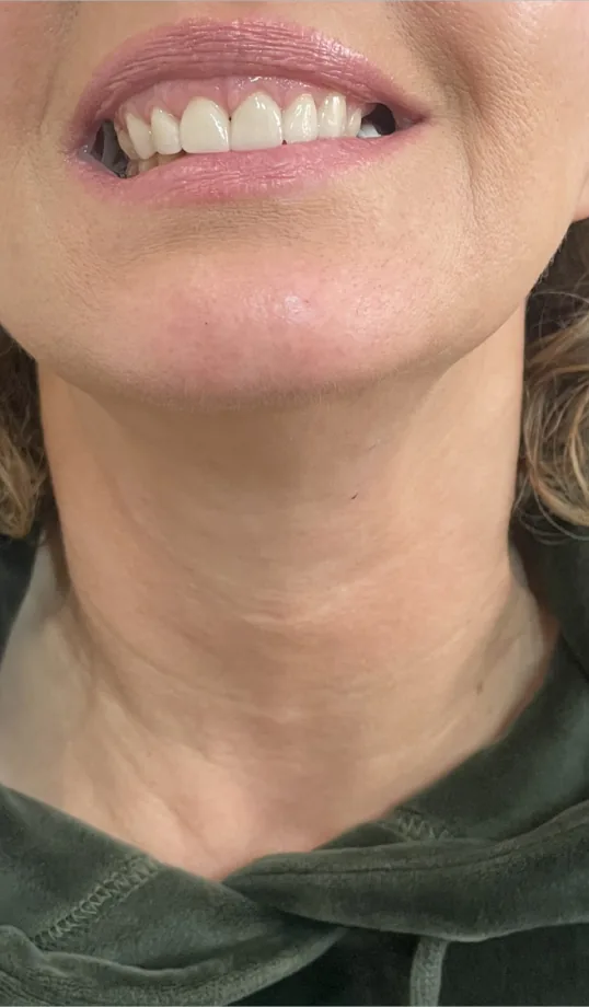 After anti-wrinkle injections, neck
