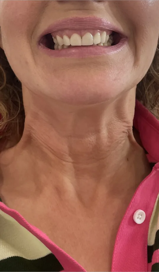 Before anti-wrinkle injections, neck