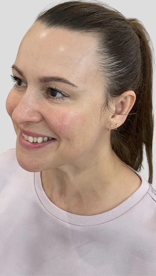 After anti-wrinkle injections, upper face