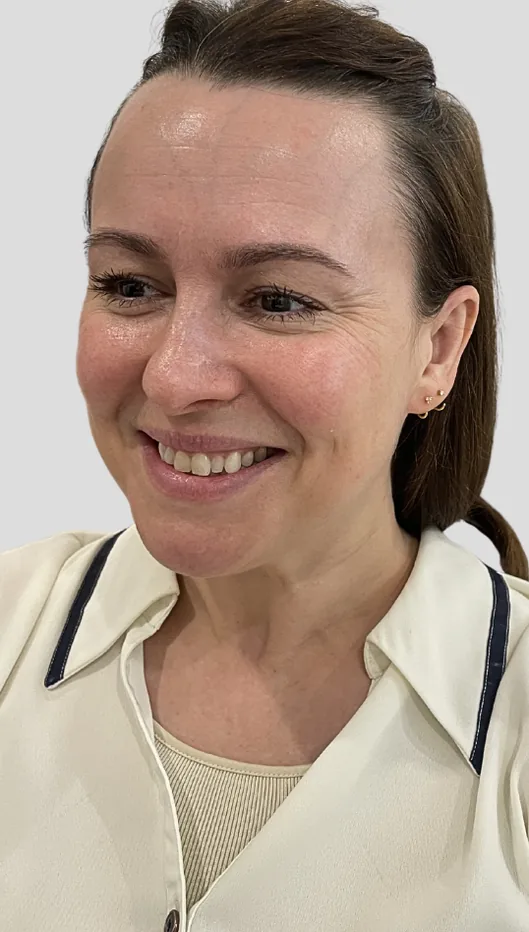 Before anti-wrinkle injections, upper face