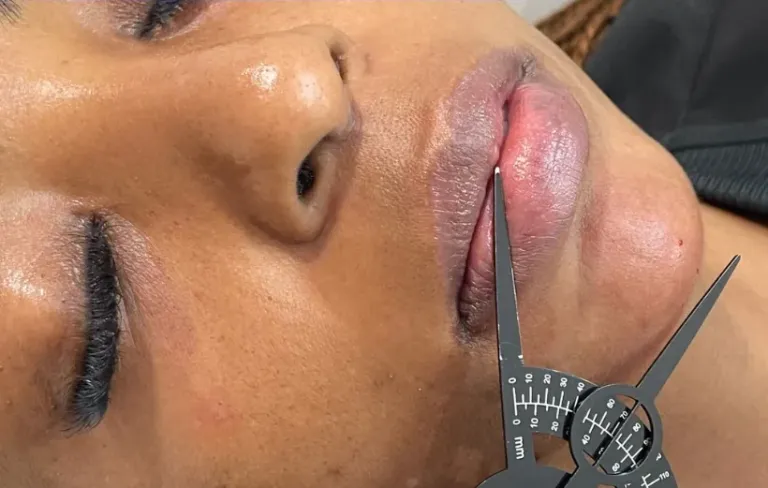 After dermal filler, chin