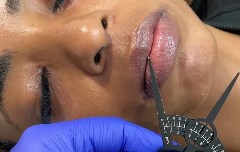 Before dermal filler, chin