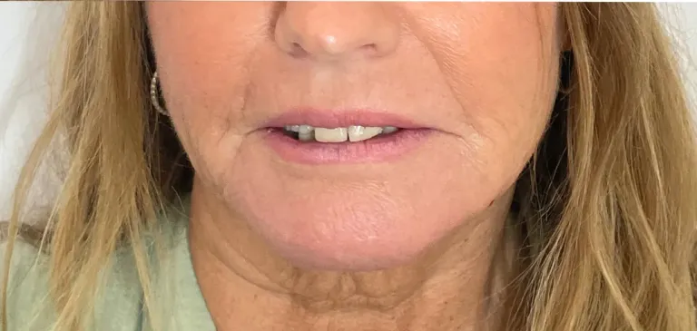 After dermal filler, chin and pre-jowl