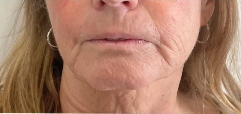 Before dermal filler, chin and pre-jowl