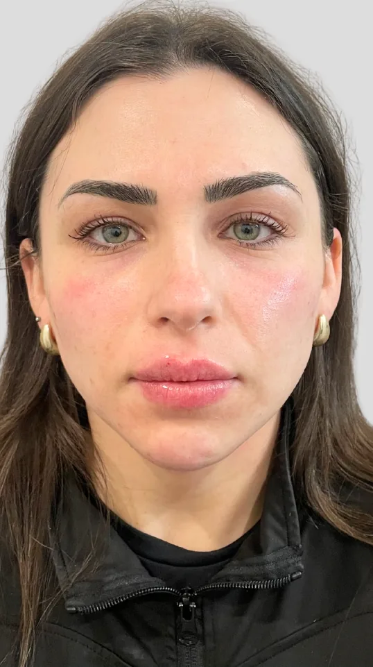 After dermal filler, full face