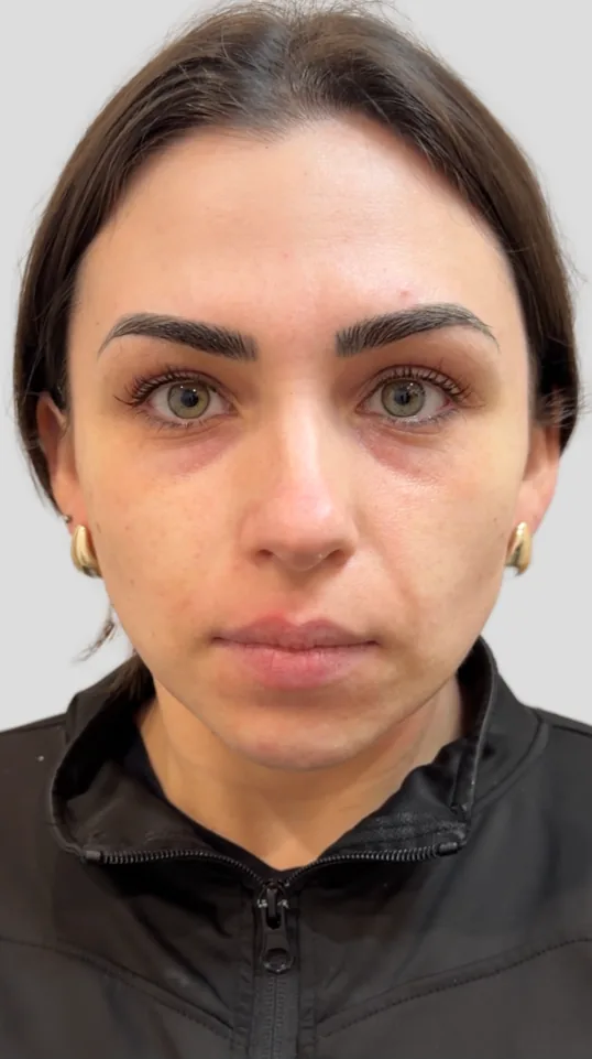 Before dermal filler, full face
