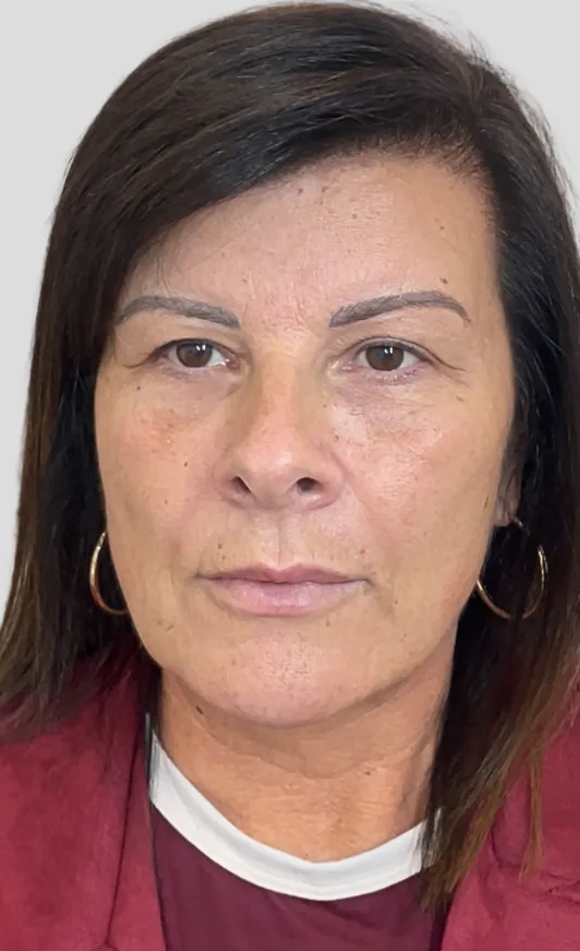 After dermal filler, full face