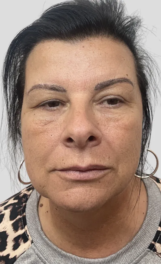 Before dermal filler, full face