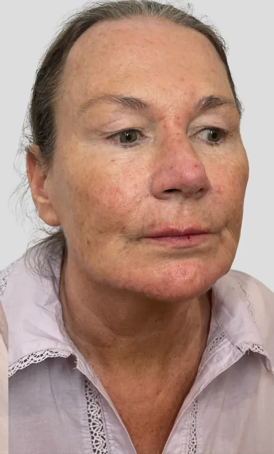 After dermal filler, full face