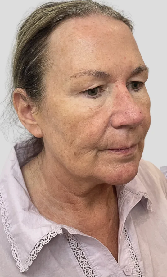 Before dermal filler, full face