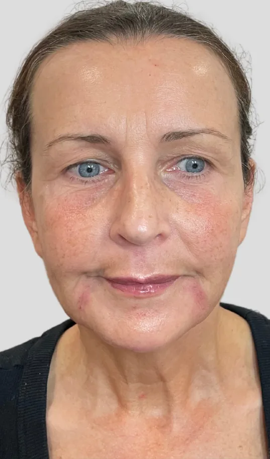 After dermal filler, full face