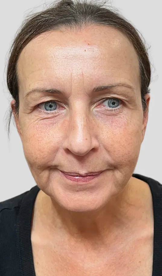 Before dermal filler, full face