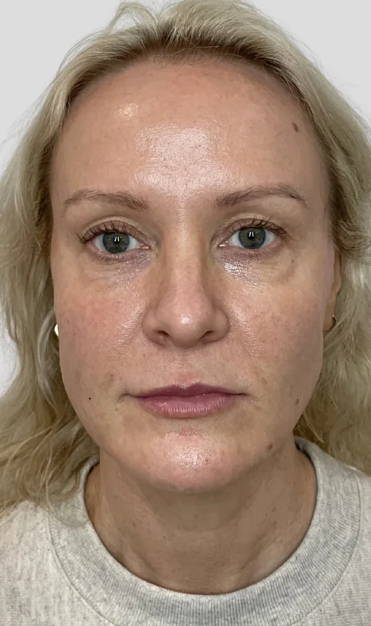 After dermal filler, full face