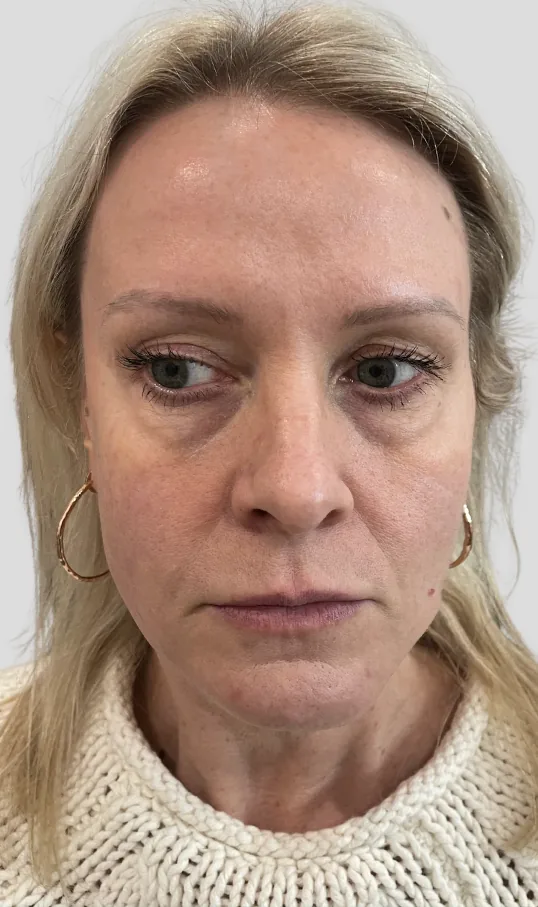 Before dermal filler, full face