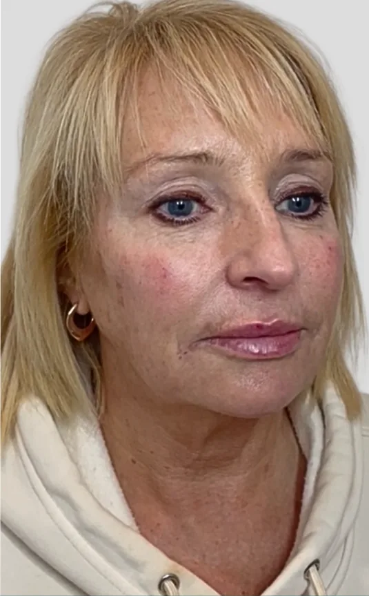 After dermal filler, full face