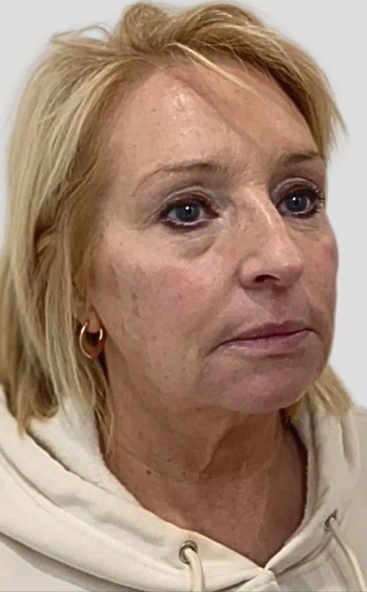 Before dermal filler, full face