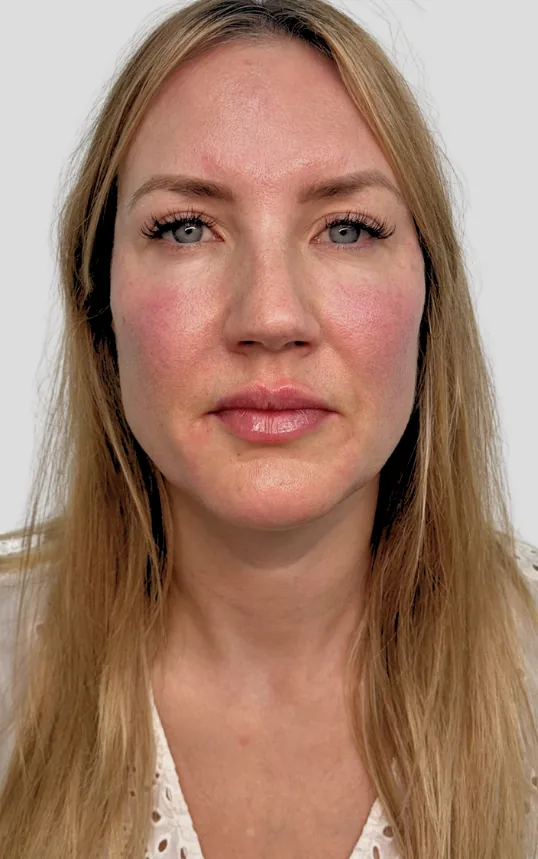 After dermal filler, full face