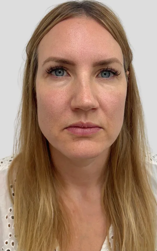 Before dermal filler, full face