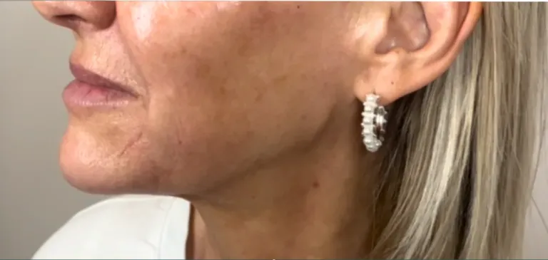 After dermal filler, jawline