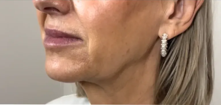 Before dermal filler, jawline