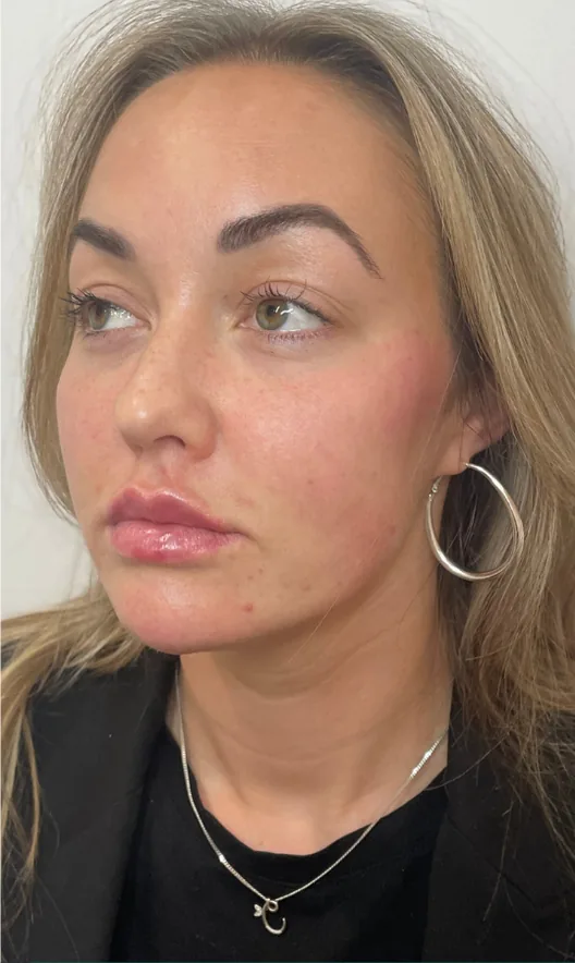 After dermal filler, lips, cheeks and chin